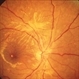 Autosomal Dominant Müller Cell Dystrophy OD Autosomal Dominant Müller Cell Dystrophy OD